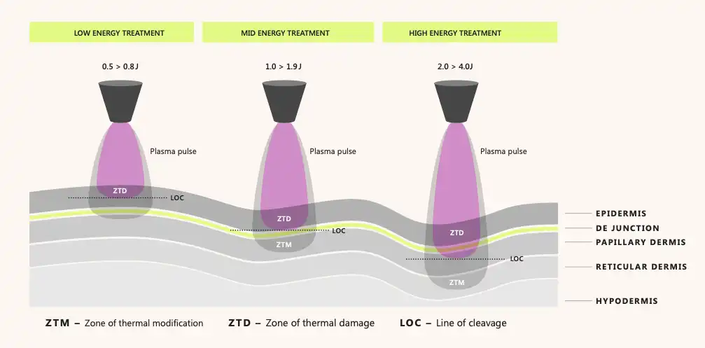 Neogen Nitrogen Plasma Therapy