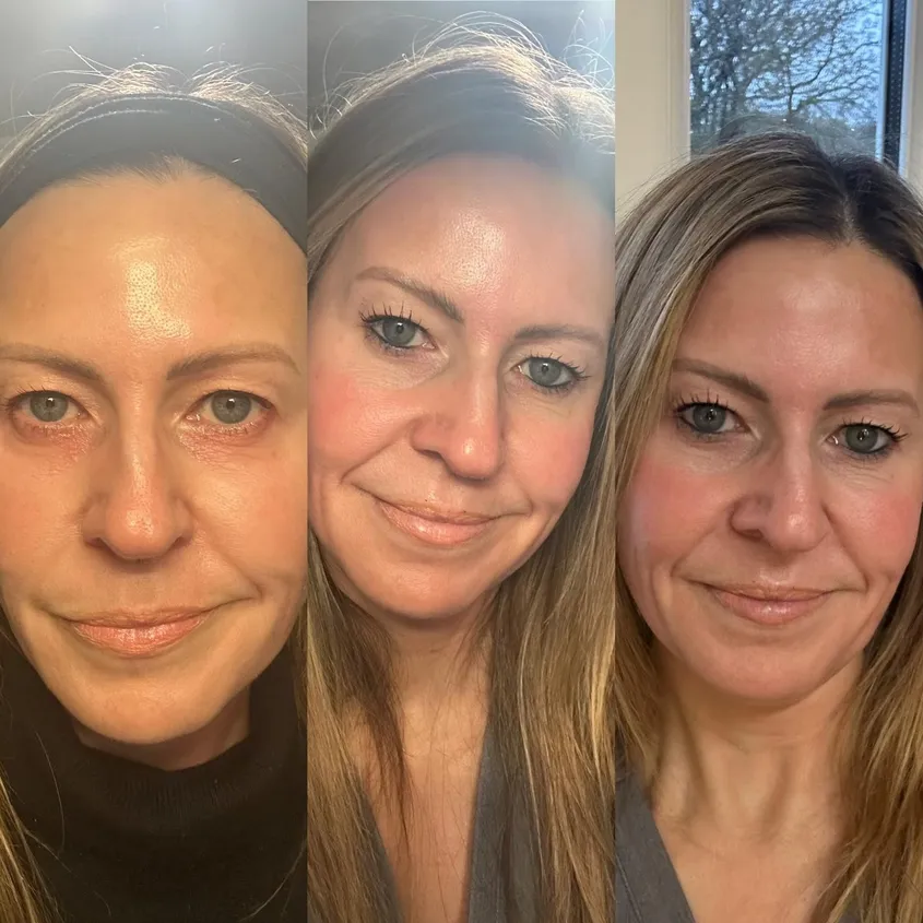 ZO Skin Health before and after results showing improved skin texture and tone